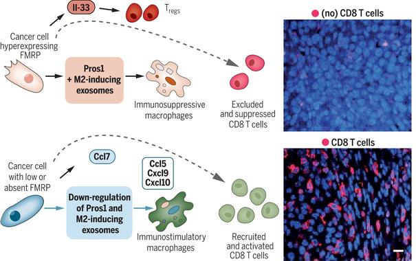"Up-regulated FMRP expression and activity are involved in an immunosuppressive program in cancer cells (upper left) that renders tumors impenetrable, creating so-called immune deserts (upper right). By contrast, its absence is associated with a reprogrammed tumor microenvironment that recruits and activates T lymphocytes, producing inflamed tumors, including CD8 T cells (red immunostain; lower right) with consequently beneficial immune destruction. Tregs, regulatory (immunosuppressive) T cells"