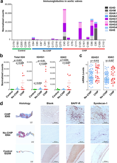 Figure from a paper: A) Normalized counts of immunoglobulins in the aortic valves by patient, with several of the clonal hematopoiesis (CH) patients having orders of magnitude higher levels. B) Quantification of IGH, IGHG1, IGKC, all higher in the CH group. C) IGHG1 and IGKC mRNA levels, higher in CH. D) Histology images of the aortic valves with stains showing activated B or plasma cells in the valves of a CH carrier compared to non-CH carrier with calcified valve and a non-CH non-calcified control