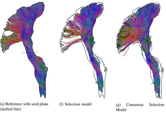 Example tractography of the corticospinal tract, demonstrating that  bootstrap consensus achieves a more complete overlap compared to a standard model selection approach.
