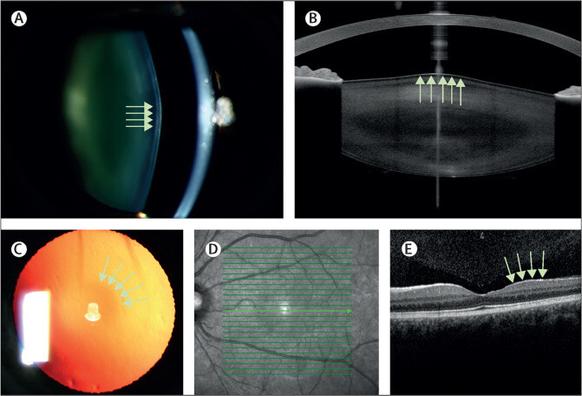 FigureOphthalmologic findings in Alport syndrome
(A) Slit-lamp examination shows an anterior lenticonus (arrows). (B) Anterior segment swept-source optical coherence tomography (OCT) clearly shows the anterior lenticonus (arrows). (C) Slit-lamp examination, with retro-illumination, shows the anterior lenticonus as the oil-droplet sign (arrows). (D and E) Posterior segment OCT shows central fleck retinopathy and temporal retinal thinning (arrows).