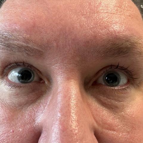 Selfie, focused on the eyes. The eyes are fully dilated because of recent laser surgery.
