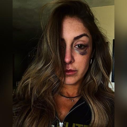 AEW's Britt Baker photographed with a nasty visible black eye.