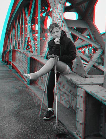 Mädchen mit Gipsbein, das die auf die Handgriffe der Krücken abgelegt hat. Sie sitzt auf dem Eisenbogen einer Brücke. Stereobild.