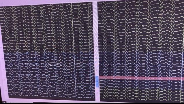 Screenshot of ephys signals from 16 tetrodes, 1 row is one channel, there is a weird 10Hz like bump on all channels