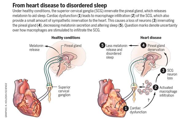 From heart disease to disordered sleepUnder healthy conditions, the superior cervical ganglia (SCG) innervate the pineal gland, which releases melatonin to aid sleep. Cardiac dysfunction (1) leads to macrophage infiltration (2) of the SCG, which also provide a small amount of sympathetic innervation to the heart. This causes a loss of neurons (3) innervating the pineal gland (4), decreasing melatonin secretion and altering sleep (5). Question marks denote uncertainty over how macrophages are stimulated to infiltrate the SCG.GRAPHIC: K. HOLOSKI/SCIENCE