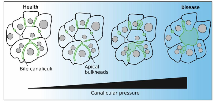 Schematic showing the changes in liver architecture upon increased bile pressure.
Canaliculi producing bile are forming small tubes between two hepatocytes. With increasing pressure, the canaliculi are forming bulkheads and when pressure is too strong the bulkheads can't hold the canaliculi shape and turn into so-called rosettes.