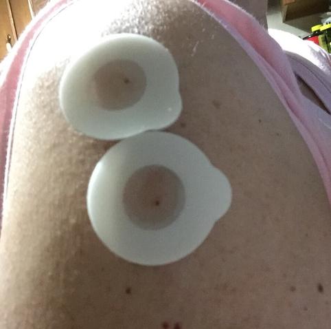 Close and blurry and altogether bad shot showing the top of my left shoulder, where two circular self-adhesive vaccine barriers (a ring of foam with a transparent center through which the shot is administered.