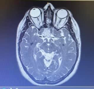 Black & White MRI scan of my brain showing brain tumour located between the pituitary gland and optic nerve.