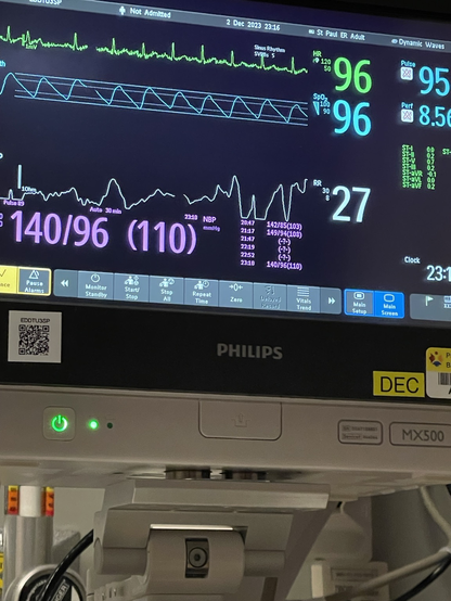 Ecg monitor showing one PAC.