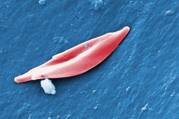 Electron microscopy picture of a misshapen red blood cell