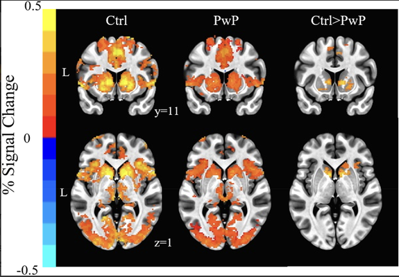 Differences in FMRI responses during reward anticipation for controls versus patients with psychosis
