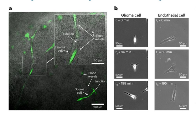 The figure shows brain cancer cells migrating in a tissue ex vivo. This glioma cells move on top of blood vessels that presents branches. 
The picture also shows cells migrating in vitro over micropatterns that mimic the same situation.