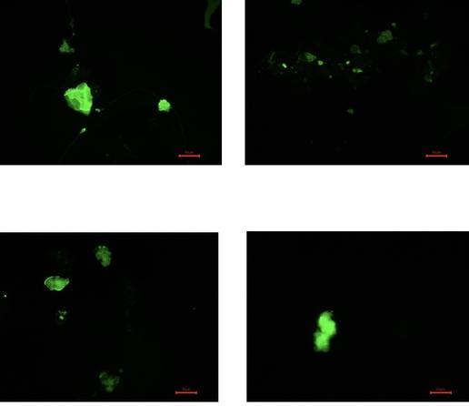 Four panels of my blood sample with bright green fluorescent blobs that are severe microclots, often found in Long Covid patients and MECFS patients who never got Covid