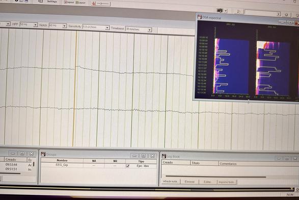 Computer screens displaying electroencephalogram (EEG) data with one screen showing brainwave traces and another showing spectral analysis.