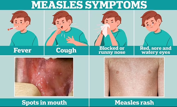 Various symptoms of measles. Fever, Cough, Blocked or running nose, red, sore and watery eyes, spots in mouth, measles rash. Image from: https://www.dailymail.co.uk/health/article-12991379/Symptoms-measles-runny-nose-rash-tell-apart.html