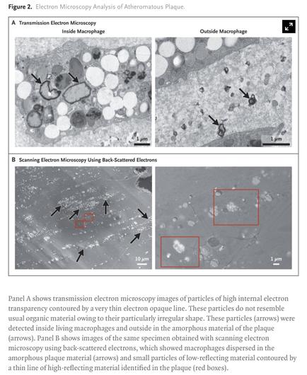 Panel A shows transmission electron microscopy images of particles of high internal electron transparency contoured by a very thin electron opaque line. These particles do not resemble usual organic material owing to their particularly irregular shape. These particles (arrows) were detected inside living macrophages and outside in the amorphous material of the plaque (arrows). Panel B shows images of the same specimen obtained with scanning electron microscopy using back-scattered electrons, which showed macrophages dispersed in the amorphous plaque material (arrows) and small particles of low-reflecting material contoured by a thin line of high-reflecting material identified in the plaque (red boxes).