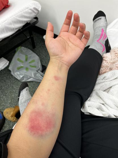 The inner forearm of my daughter showing a huge circular red and purple bruise and a number of smaller ones.