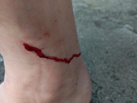 fresh blood oozing from my lower leg following the removal of a chonky leech boi