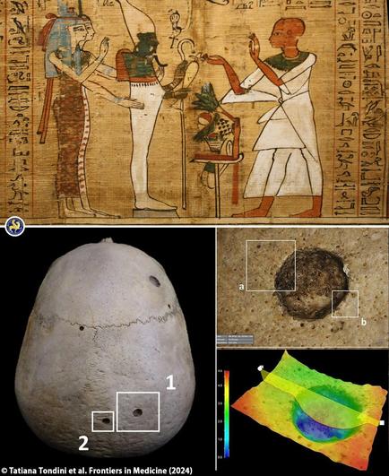Ancient Egyptian doctors tried to treat cancer 4,000 years ago

In a recent study published in the journal Frontiers in Medicine, researchers have unveiled evidence suggesting that ancient Egyptians, more than 4,000 years ago, may have attempted to treat cancer through surgical interventions.

The study, led by an international team of researchers, focused on two skulls dating back to ancient Egypt. One skull, belonging to a male aged 30 to 35, showed evidence of a large primary tumor and over 30 smaller metastatic lesions. Microscopic analysis revealed cut marks around these lesions, indicating attempts at surgical intervention. This finding suggests that ancient Egyptians may have sought to remove cancerous growths, pushing back the timeline of surgical cancer treatment by millennia.