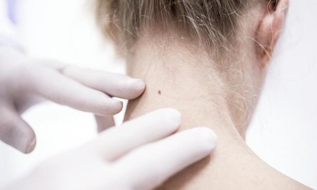 Mujer siendo examinada por posible cáncer de piel (Getty Images/Science Photo Libra)
