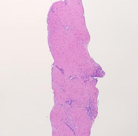 Photomicrograph of a prostate core needle biopsy which resembles the Moai statues of Easter Island
