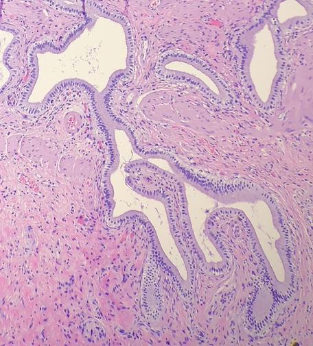 Photomicrograph of a gallbladder in which the glands are shaped like a giraffe