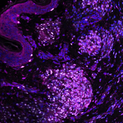 The whole image from which the cover image had been taken, from a confocal microscopy stack of immunofluorescence in congenital melanocytic nevus skin. White nuclei express the melanocytic transcription factor SOX10, magenta shows beta-spectrin expression and blue show DAPI staining of DNA in nuclei.