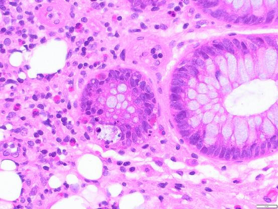 Microscopy image of an HE stained slide with a colon crypt. In the crypt apoptotic cells can be observed (dropped out and fragmented leaving a clear space).