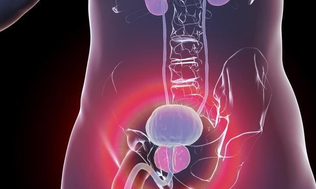 Ilustración de un cáncer de próstata (Getty Images/Science Photo Libra)