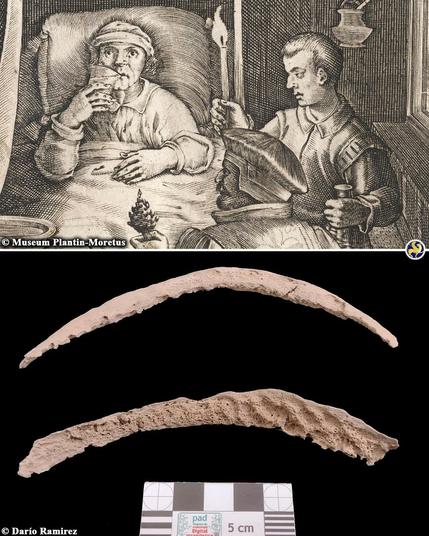 Syphilis originated in the Americas and spread to Europe through colonialism, ancient DNA reveals

The origins of syphilis, a sexually transmitted infection that devastated Europe during the late 15th century, have puzzled researchers for decades. A new study, published in Nature, provides groundbreaking insights into the debate over whether the disease originated in the Americas or existed in Europe before the voyages of Christopher Columbus. Drawing on ancient DNA from archaeological remains across the Americas, the study strongly supports the hypothesis that syphilis and its related diseases have deep roots in the Americas.