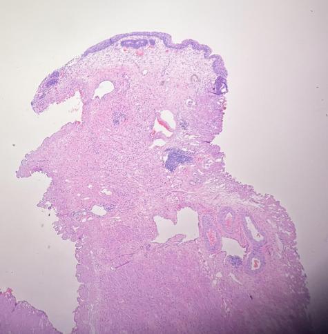 Photomicrograph of a piece of prostate tissue from a transurethral resection, resembling someone