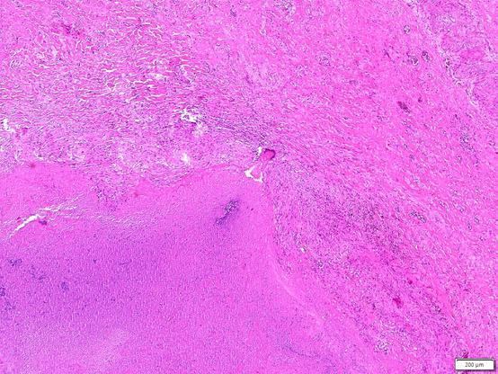 Necrotizing granuloma with a multinucleated giant cell seemingly bursting out to the periphery.