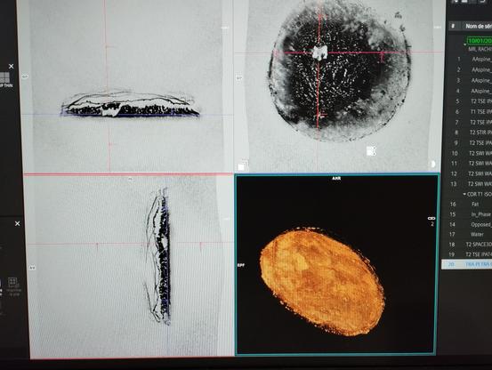 IRM d'une galette des rois.
Acquisition 3D Petra Ultra Low TE.
Siemens Magnetom Altea 1.5 Tesla