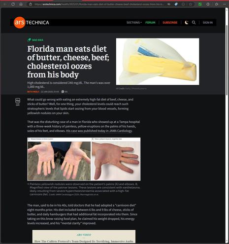 https://arstechnica.com/health/2025/01/florida-man-eats-diet-of-butter-cheese-beef-cholesterol-oozes-from-his-body/