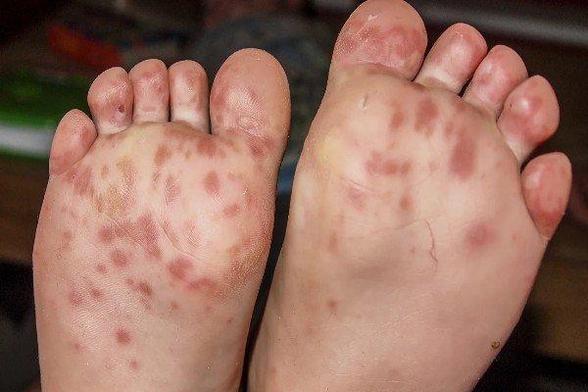 Hand, Foot, and Mouth Disease in Nevis.jpg