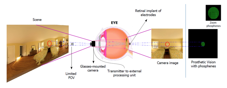 Overview of a retinal prosthesis. The external and internal components include a glasses-mounted camera, an external processing unit and an implanted electrode array. First, the external camera acquires an image. Then, the external processor converts the image to a suitable pattern of electrical stimulation of the retina through an electrode array. The result is a phosphene image with limited field of view (FOV).