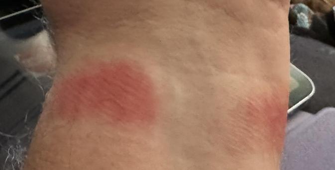 No filters used. That’s the exact look of the rash from my watchband. Red and angry.