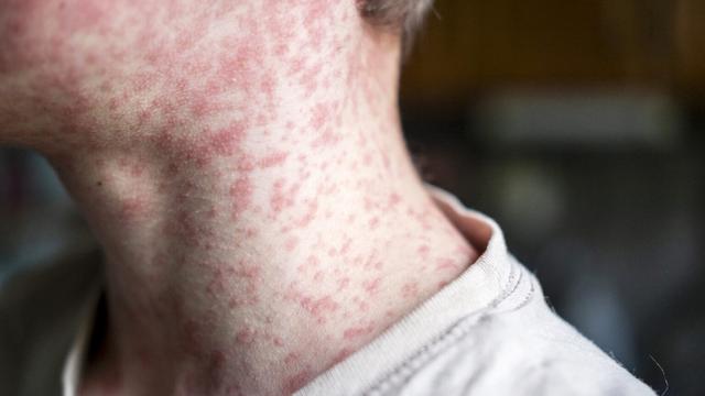This image shows a close-up of a person’s neck and lower face, covered in a red, blotchy rash characteristic of measles. The rash consists of small, raised red spots that are densely clustered, giving the skin an inflamed and irritated appearance. The person is wearing a light-colored shirt, and the background is blurred, likely indoors.

Measles rashes typically start on the face and spread downward to the rest of the body. The disease is highly contagious and can cause serious complications, especially in children and those with weakened immune systems. This image visually highlights the impact of measles and underscores the importance of vaccination to prevent outbreaks.