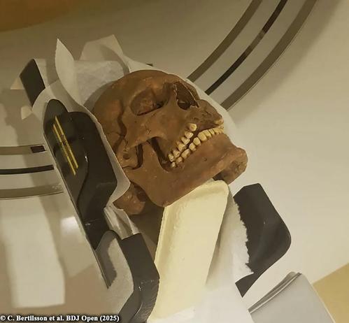 CT scans of Viking-age skulls reveal widespread disease

A new study by scientists at the University of Gothenburg has shed light on the health of Viking-age people in Sweden, showing they suffered from many infections and skeletal diseases. The research, which was published in the British Dental Journal Open, used advanced CT scans to analyze the skulls of 15 Viking-era individuals. It found evidence of chronic ailments that would have made their lives much harder...