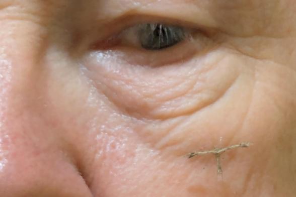Eye, cheek and part of a nose with a small T-shaped moth sitting on the cheek.