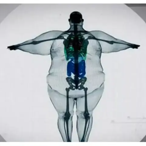 Image of a x-ray of a 400 kg man. Normal skeleton, but with a huge amount of flesh on it. Front-view.