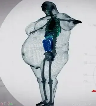 Image of a x-ray of a 400 kg man. Normal skeleton, but with a huge amount of flesh on it. Side view..