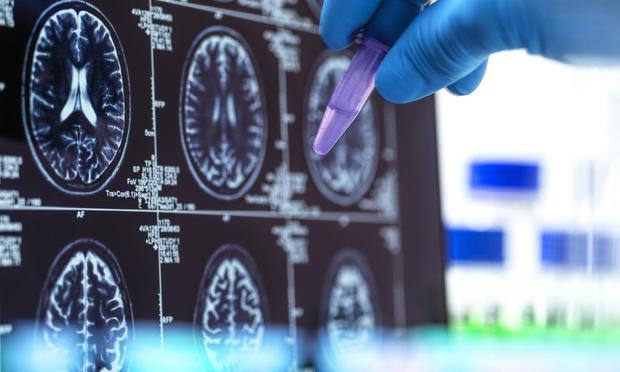 Una imagen de archivo de un escáner cerebral (Andrew Brookes vía Getty Images)