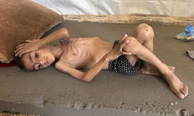 El niño gazatí Osama al Raqab, de cinco años, con desnutrición severa, el 21 de abril de 2025. (Ahmad Awad / EFE)