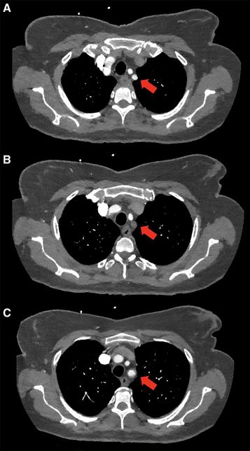 Figure. Computed tomography angiography (CTA) of subclavian artery stenosis. Axial CTA image of this patient with subclavian artery stenosis. A, Patent subclavian artery (indicated by the arrow) distal to the site of the occlusion. B, A more inferior axial image with an absence of contrast in the subclavian artery at the level of the subtotal occlusion while (C) demonstrates the most inferior and proximal to the aortic arch and re-demonstrates a patent proximal portion of the subclavian artery. This is consistent with a subtotal occlusion of the subclavian artery with distal reconstitution likely via the left vertebral artery