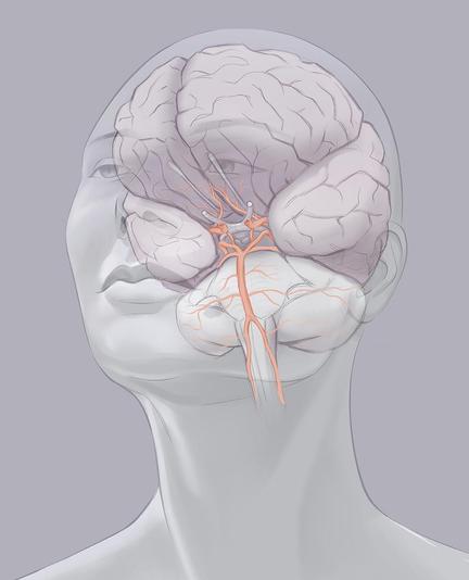 Digital illustration of a portrait with the brain and the main arteries at its base in transparency