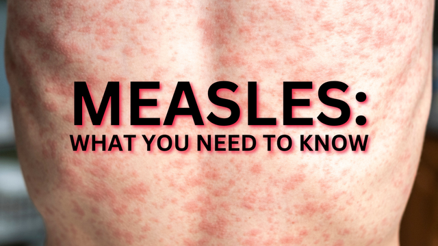 York Region Public Health investigating a confirmed case of measles.

If you attended these locations, you may have been exposed to measles:

Garden Basket Grocery Store: 9271 Markham Road in the City of Markham from 2:30 p.m. to 5 p.m. on Thursday, April 17, 2025.

Markham YMCA: 101 YMCA Boulevard in the City of Markham from 10:45 a.m. to 2 p.m. on Sunday, April 20, 2025.

https://www.york.ca/newsroom/media-release/york-region-public-health-investigating-confirmed-case-measles-0

#measles #markham #yorkregion
