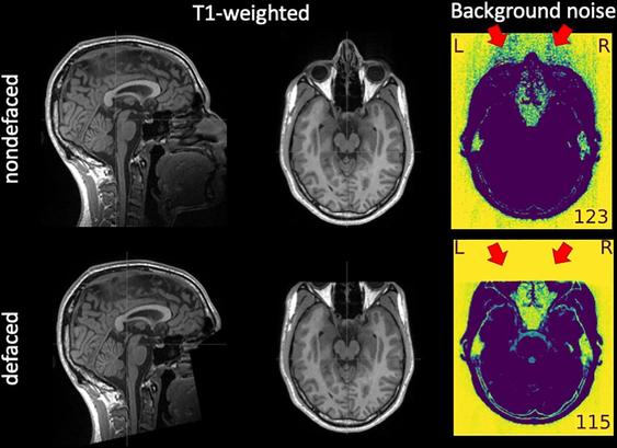 An example of T1w image before and after defacing. Defacing is typically implemented by zeroing the voxels around the face (left-hand side, panel “T1-weighted”). The “Background noise” panel shows two visualizations extracted from the MRIQC visual report, in which a window is applied to select the lowest intensities and then they are inverted to enhance patterns in the background. The red arrows indicate aliases along the anterior–posterior axis—which had the lowest bandwidth in the example—produced by eye motion. These aliases are straightforward to notice in front of the ocular globes in the “Background noise” panel of the “nondefaced” image because of the absence of signal sources. This aliasing also spreads in the opposite direction, overlapping brain tissue. However, this overlap is often very hard to notice against the signal of interest within the brain. The corresponding “defaced” version of the “Background noise” panel shows how defacing eliminates valuable information for quality assessment.