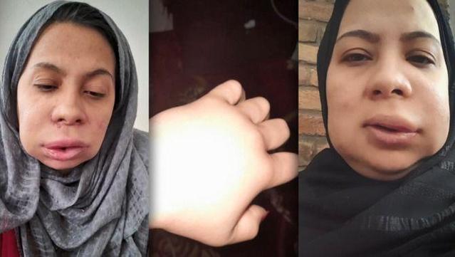 La Khatera pateix un angioedema hereditari (HAE) (Cedida)