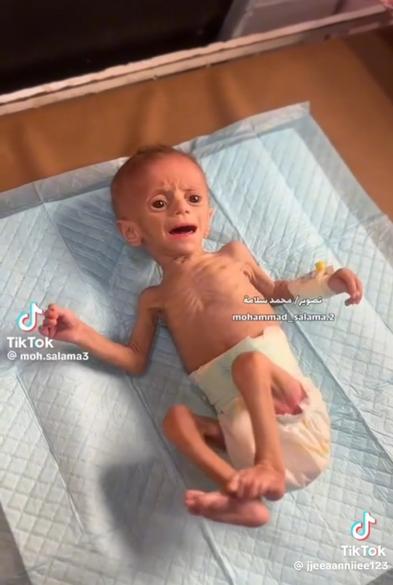 extremely malnourished and dehydrated child in Gaza